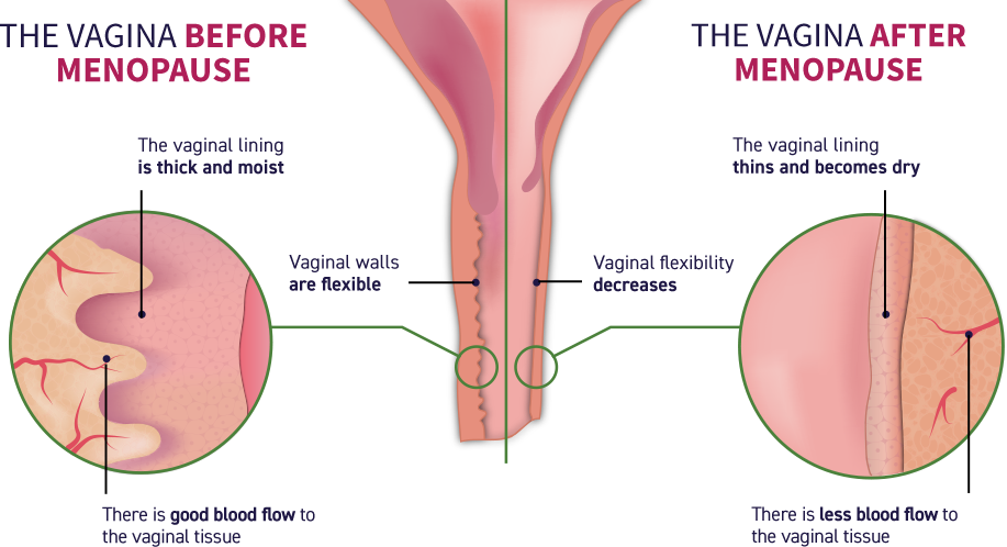Before menopause, there is good blood flow to the vaginal tissue, the vaginal lining is thick and moist, and the vaginal walls are flexible. After menopause, there is less blood flow to the vaginal tissue, the vaginal lining thins and becomes dry, the vaginal flexibility decreases, and the vagina becomes narrower and shorter.