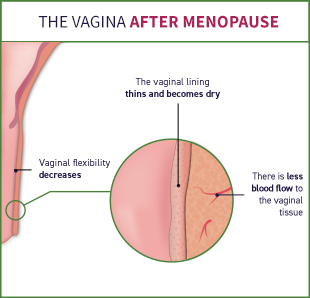 After menopause, there is less blood flow to the vaginal tissue, the vaginal lining thins and becomes dry, the vaginal flexibility decreases, and the vagina becomes narrower and shorter.