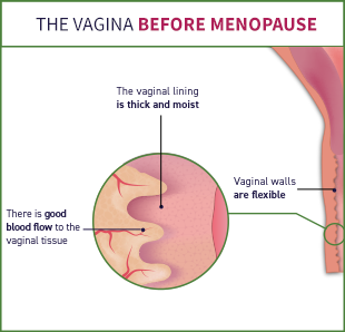 Before menopause, there is good blood flow to the vaginal tissue, the vaginal lining is thick and moist, and the vaginal walls are flexible.